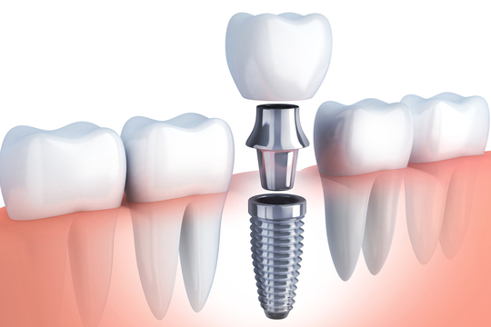 インプラント治療 脇谷歯科クリニック 松戸 松戸市六高台